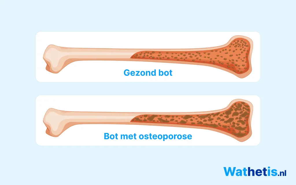 Osteoporose infographic