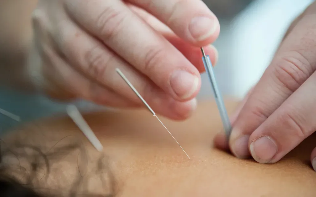 Acupunctuur technieken